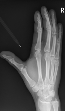 Oblique Hand Radiograph
